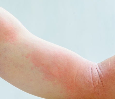 Combats skin conditions like eczema
