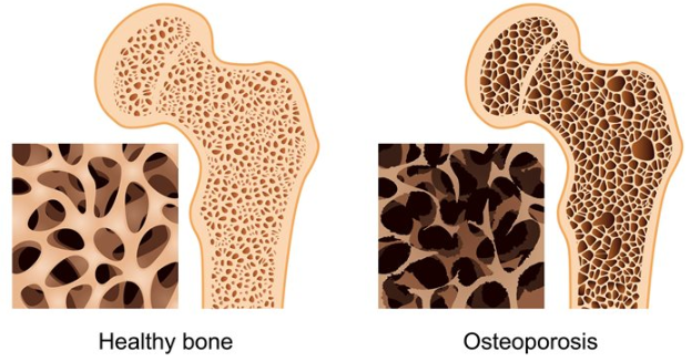 Risk of Osteoporosis